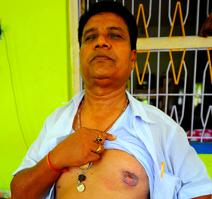 Sunil Bagh works at the cooperative bank in Ghetugachi village of Nadia district. The 52-year-old shows a skin lesion. Doctors have told him it is a result of arsenic poisoning and may turn cancerous. “I have lost eight relatives to arsenic poisoning,” Bagh says. “My father, my uncles, aunts… The doctors say my lungs are already affected. They are recommending surgery.” At Bagh’s office, colleagues can quickly list around 40 relatives, friends and acquaintances who have died due to arsenic poisoning in the last ten years or so.